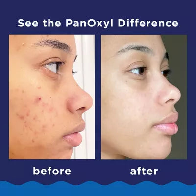 PanOxyl Maximum Strength Antimicrobial Acne Foaming Wash for Face, Chest and Back with 10% Benzoyl Peroxide - Unscented - 5.5oz